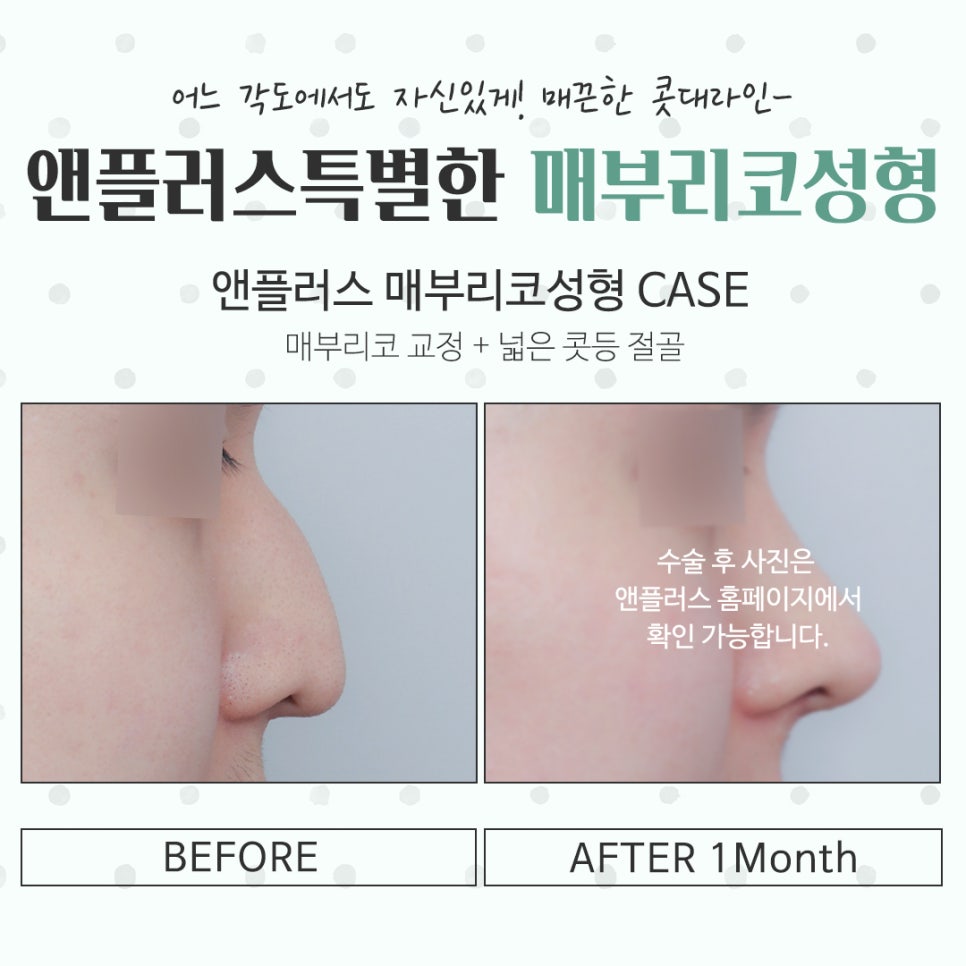 매부리코성형후기 코끝처짐을 개선하여 관련 이미지 14