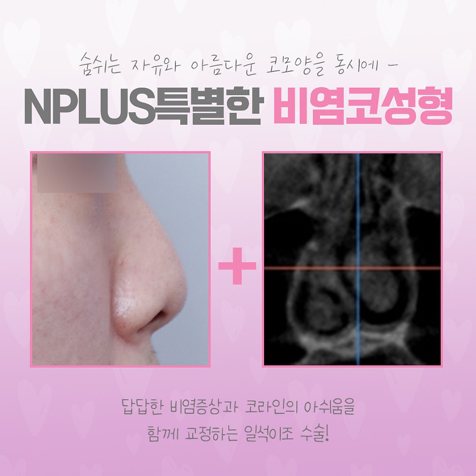 Learn in Detail About Rhinoplasty for Rhinitis image 8