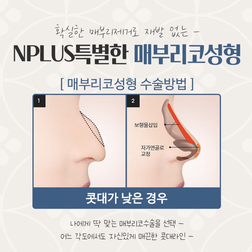매부리코수술 후기까지 상세하게 알아보고 관련 이미지 9