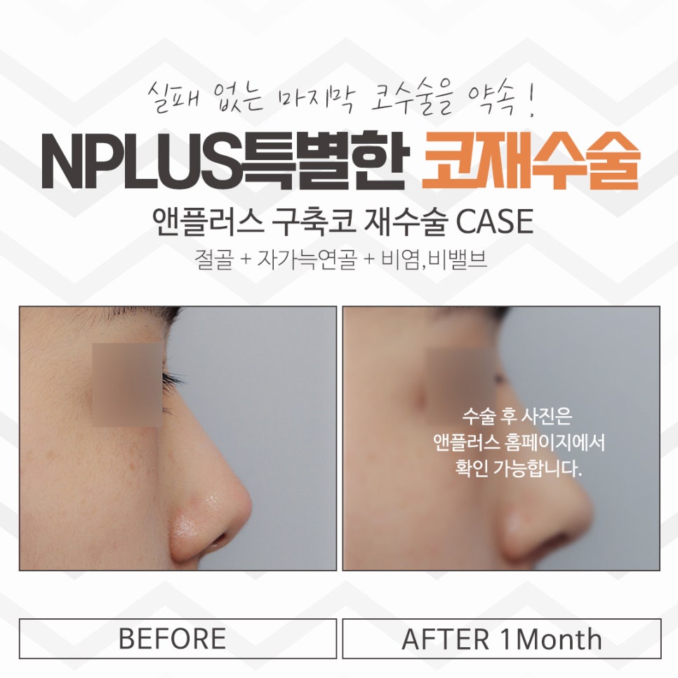 The Importance of Choosing a Revision Rhinoplasty Review image 14