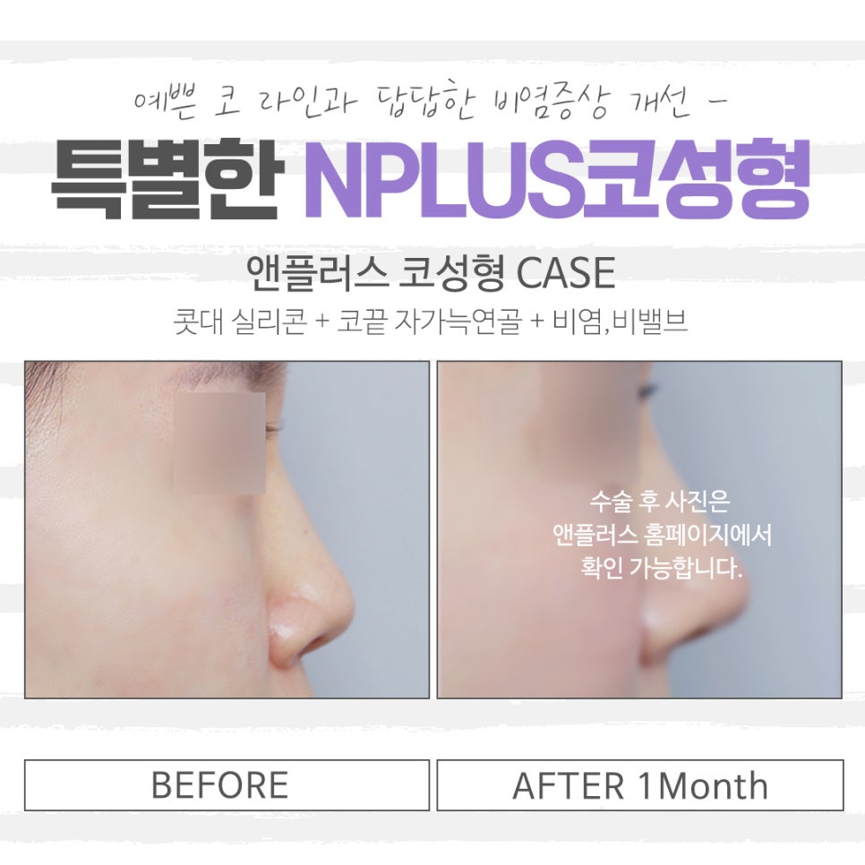 Checking Whether Low Nose Surgery Reviews Are Safe image 14