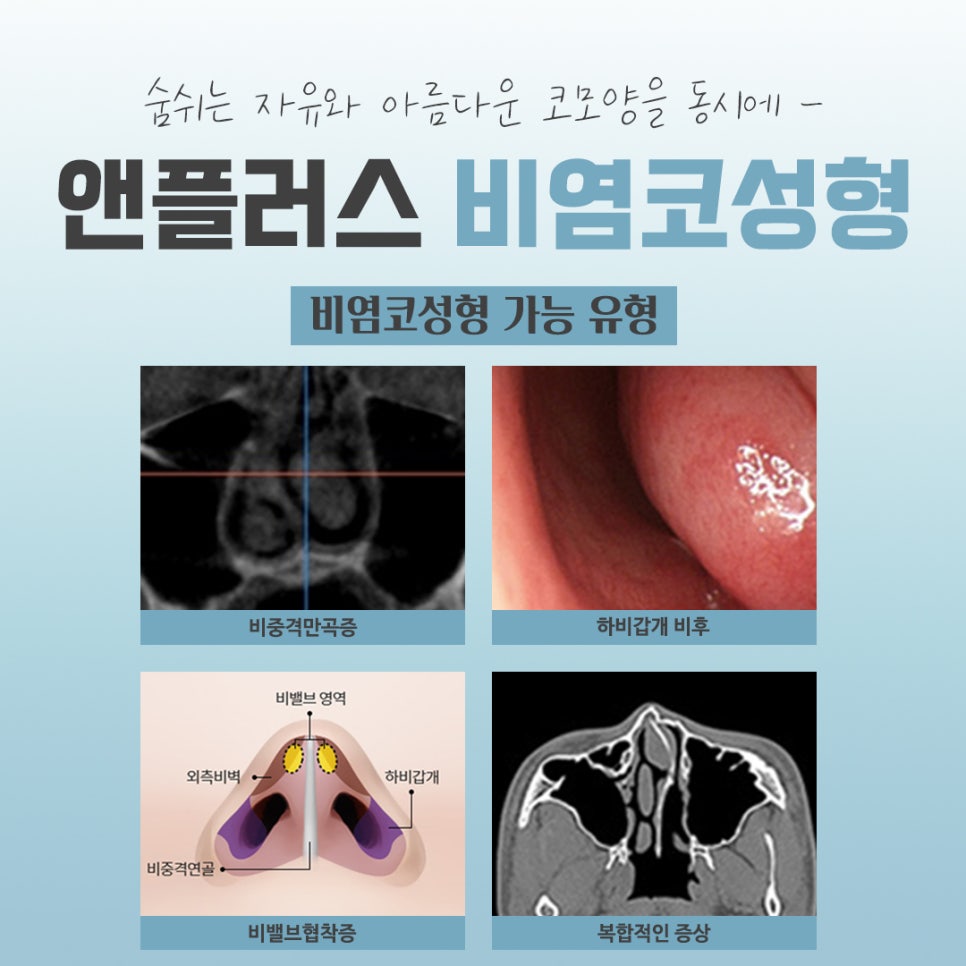 비염코수술전후에 대해 자세히 알아보고 관련 이미지 4