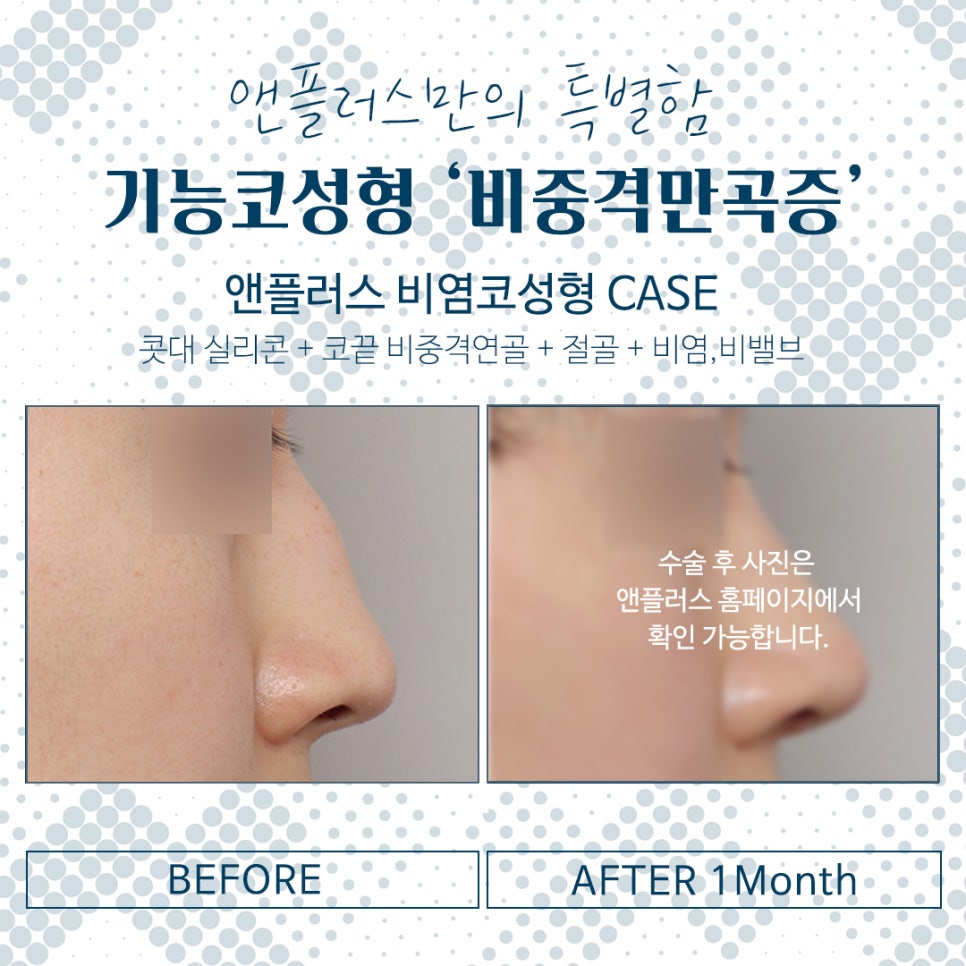 Septoplasty for Satisfying Results image 8