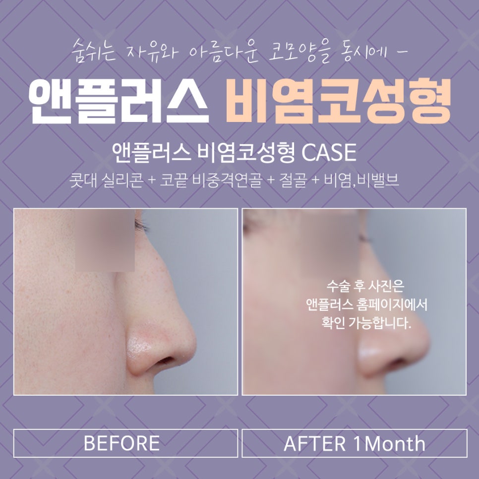 Looking Into Rhinitis Rhinoplasty Reviews and Benefits image 16