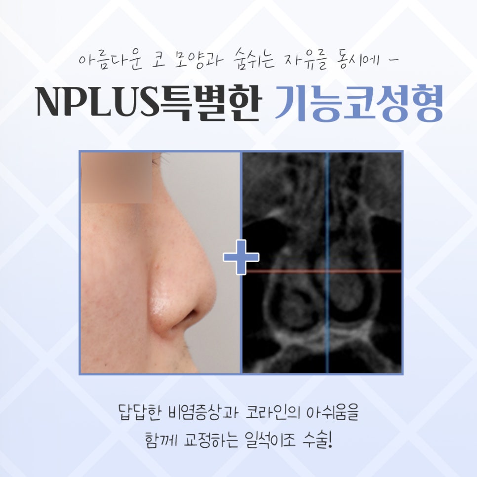 기능코성형 후기 보고 비교하여 관련 이미지 4