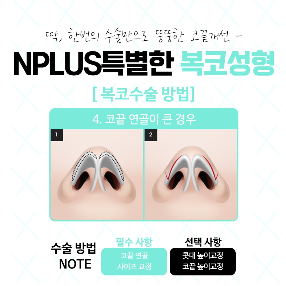 복코수술후기를 더욱 자세히 확인하고 관련 이미지 10