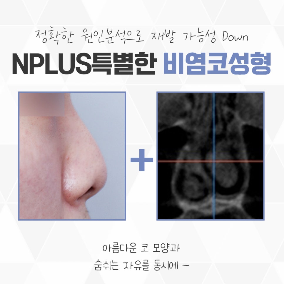 Nasal Surgery and Rhinoplasty: Identifying the Exact Cause image 3