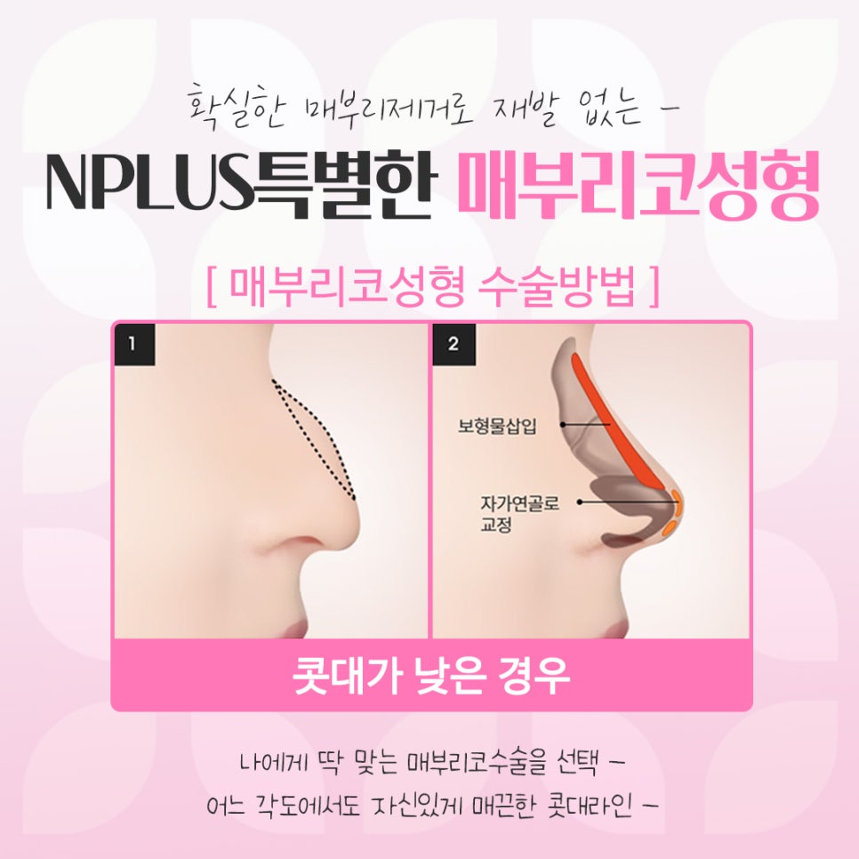 매부리코수술전후 비교를 한다면 관련 이미지 9