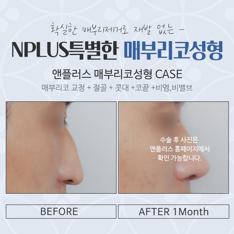 Hump Nose Surgery Review with an Accurate Diagnosis image 16