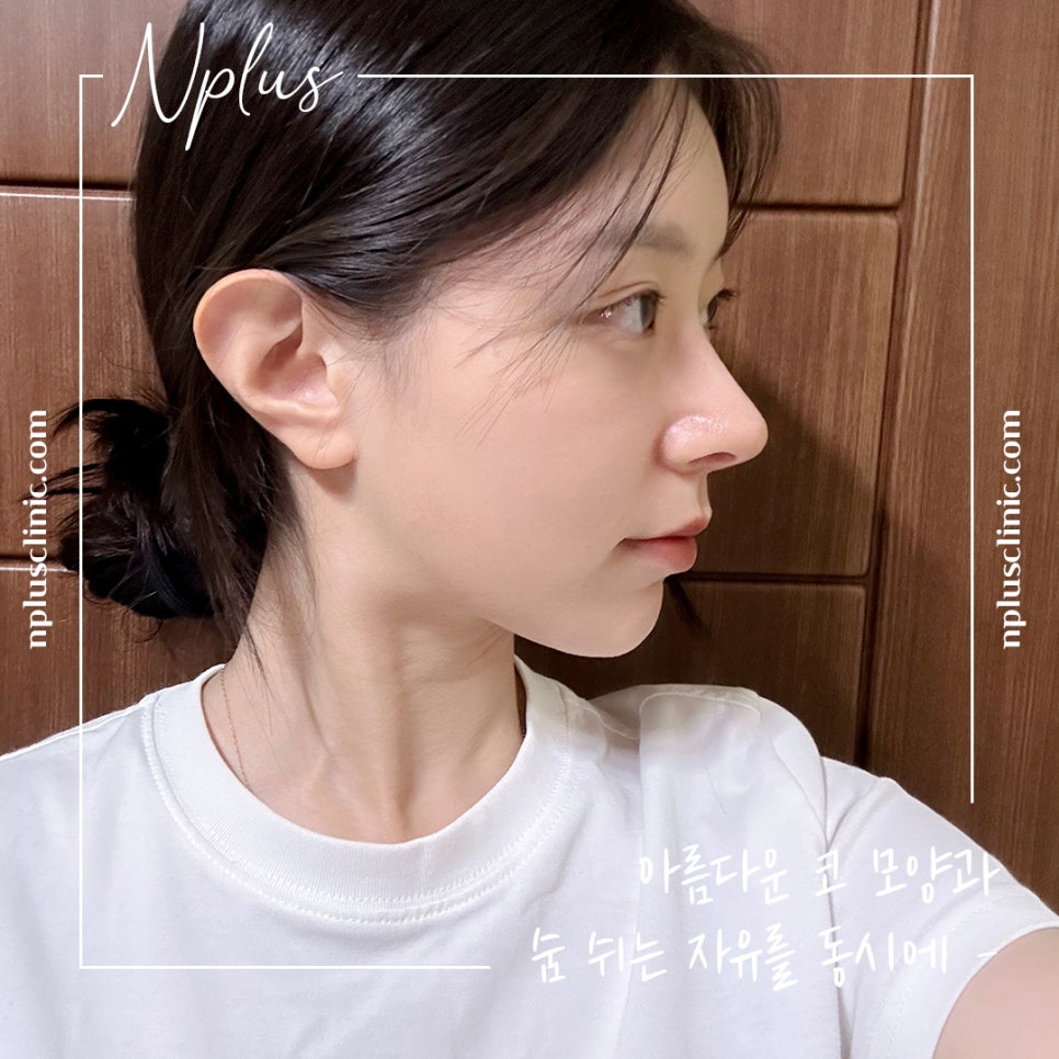 코성형후기 제대로 알아보고 관련 이미지 2