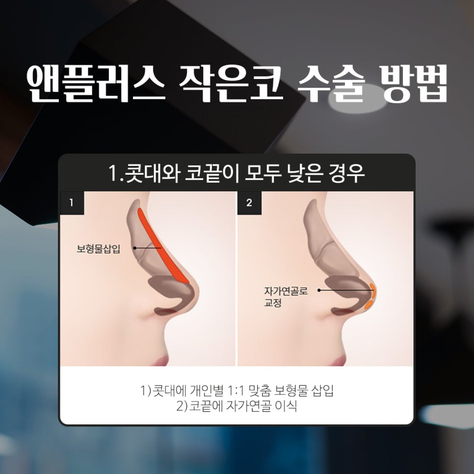성형하기 힘든 코유형 관련 이미지 4