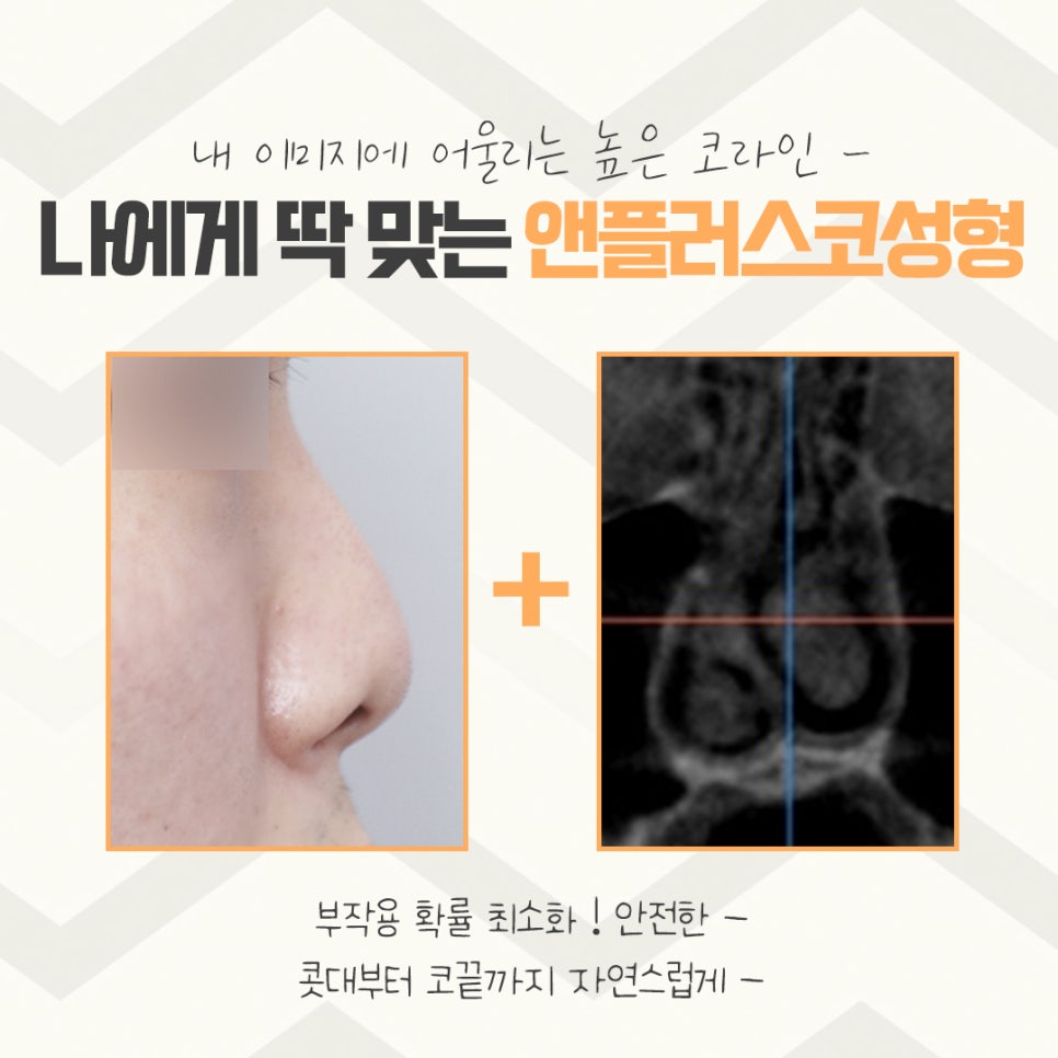 코수술후기에 대해 자세하게 알아보고 관련 이미지 4