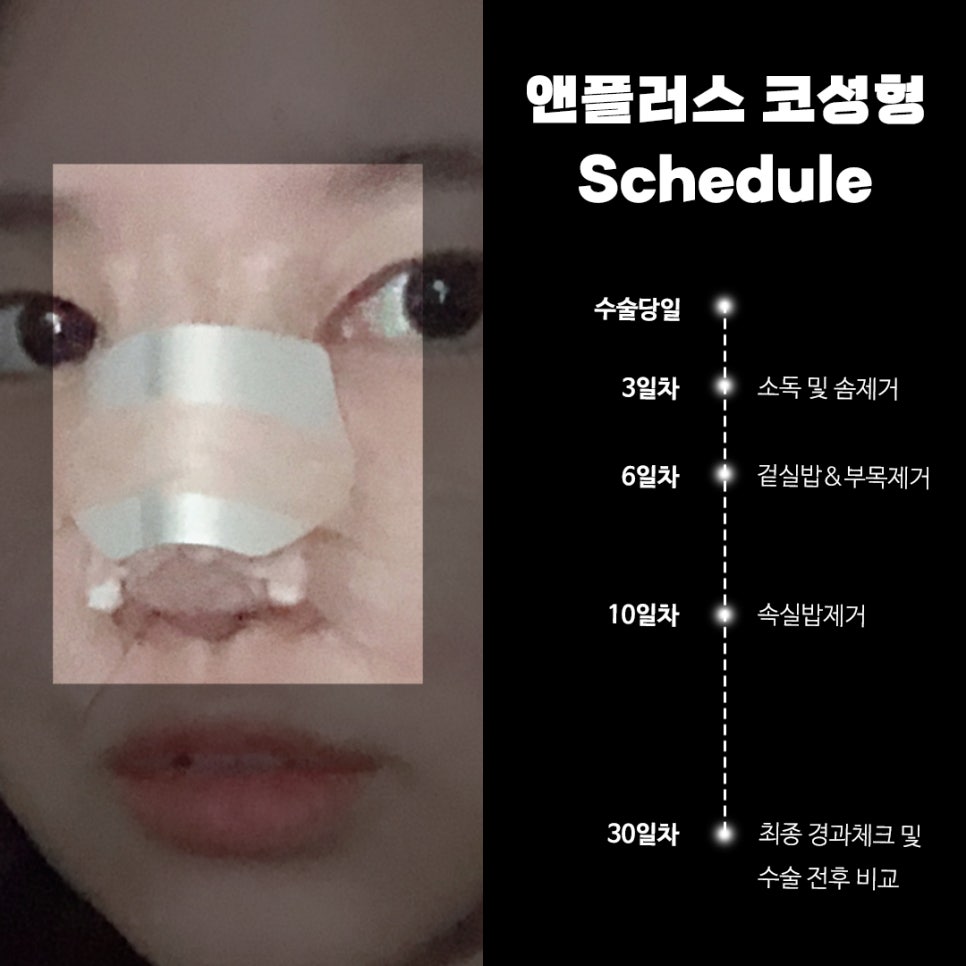A Complete Guide to Care After Nose Surgery! image 2