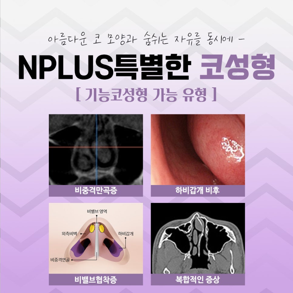 코수술전후 자연스러운 라인으로 관련 이미지 6