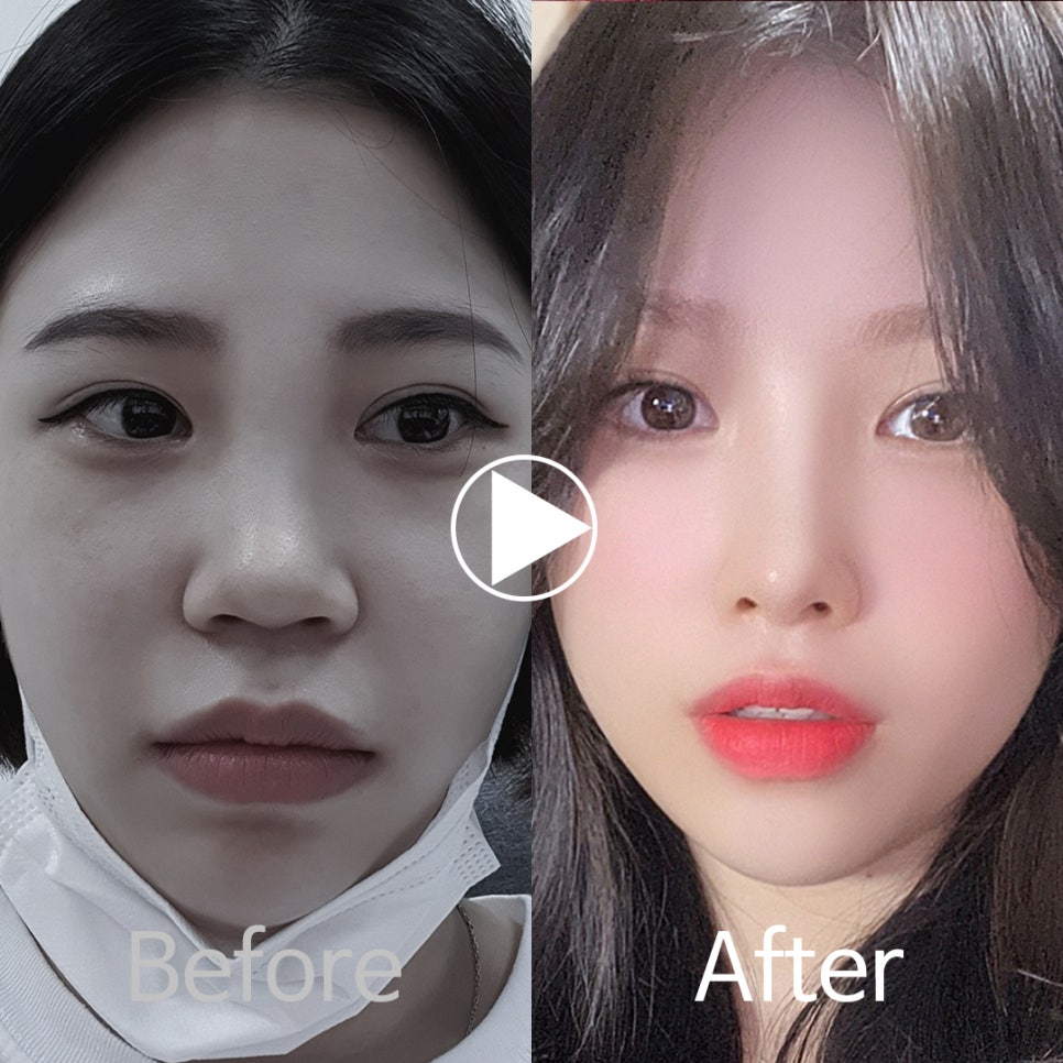 🎀앤플러스 코성형 모델모집🎀 관련 이미지 9