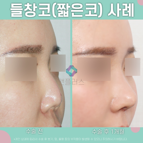 짧은코성형 복합적 교정방법 관련 이미지 2