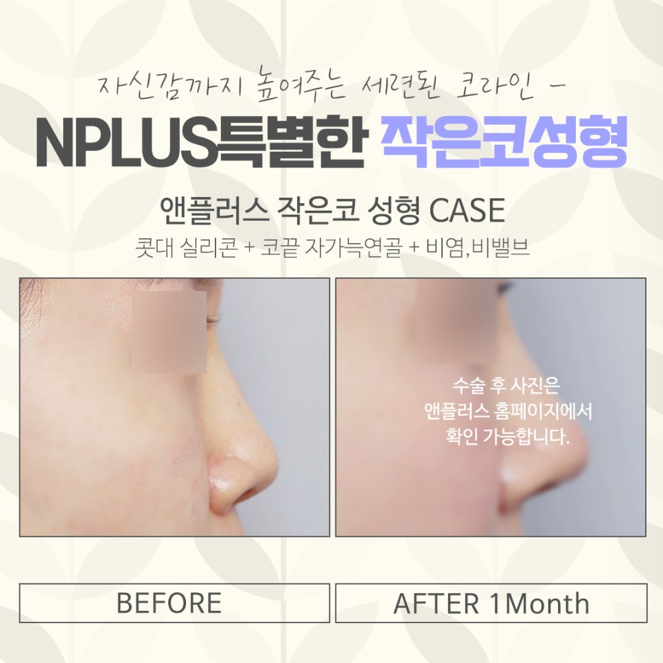 작은코성형에 대해 자세하게 확인하고 관련 이미지 11