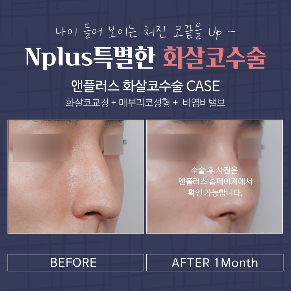 Transforming Your Look to a More Youthful Appearance After Arrow Nose Surgery image 9