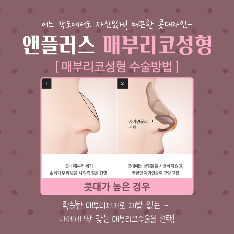 코끝처짐 개선한 매부리코성형후기 관련 이미지 8