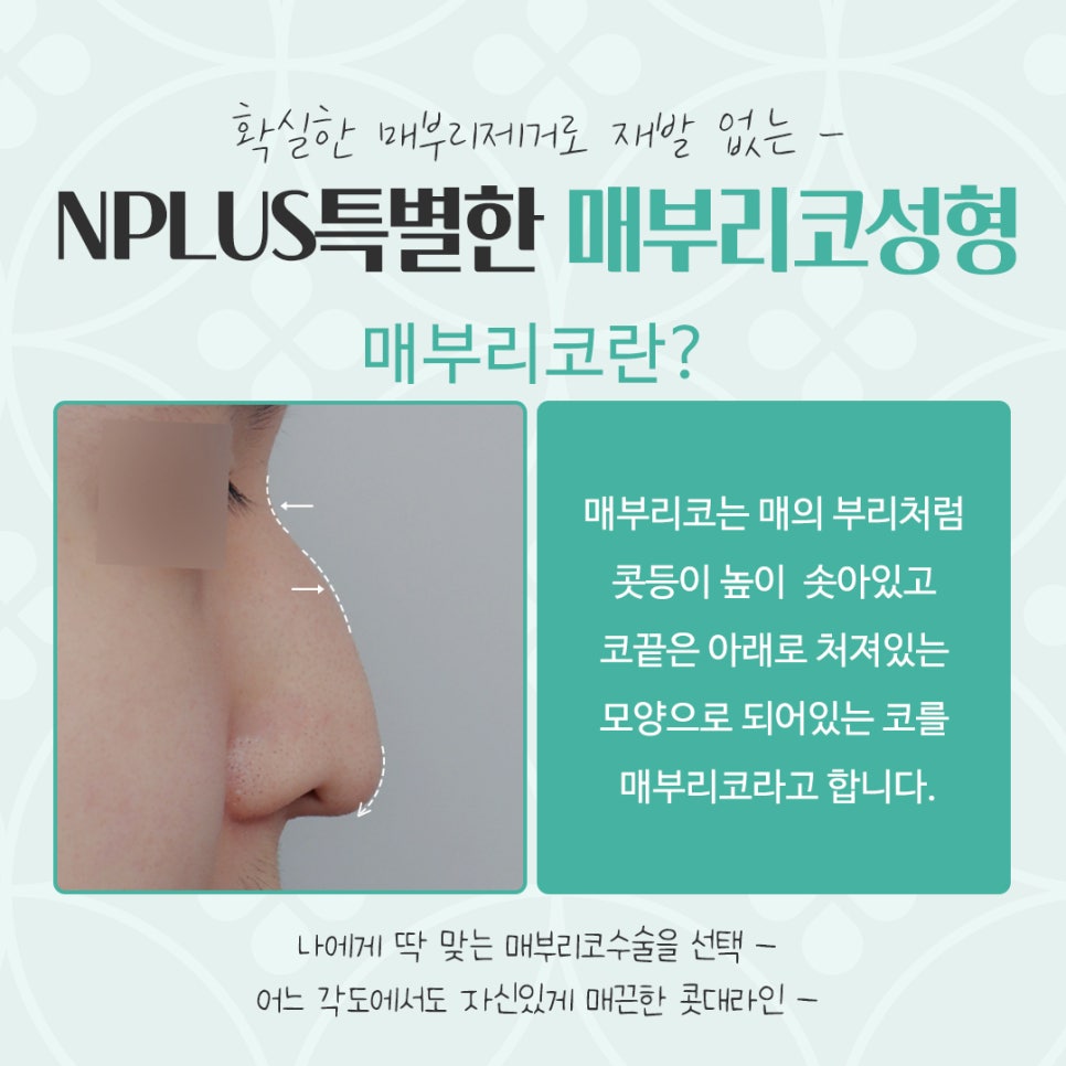매부리코수술후기 자연스럽고 세련된 라인으로 관련 이미지 3