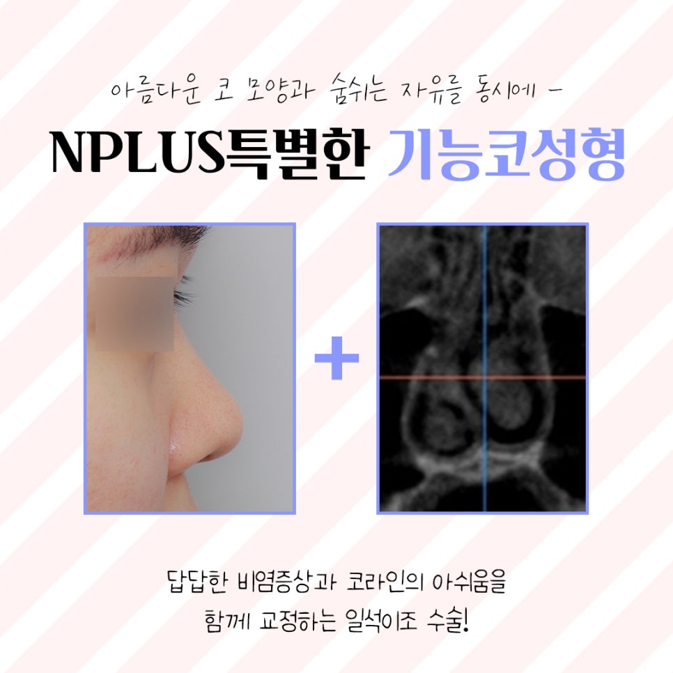 코수술후기에 대해 정확하게 진단하여 관련 이미지 6