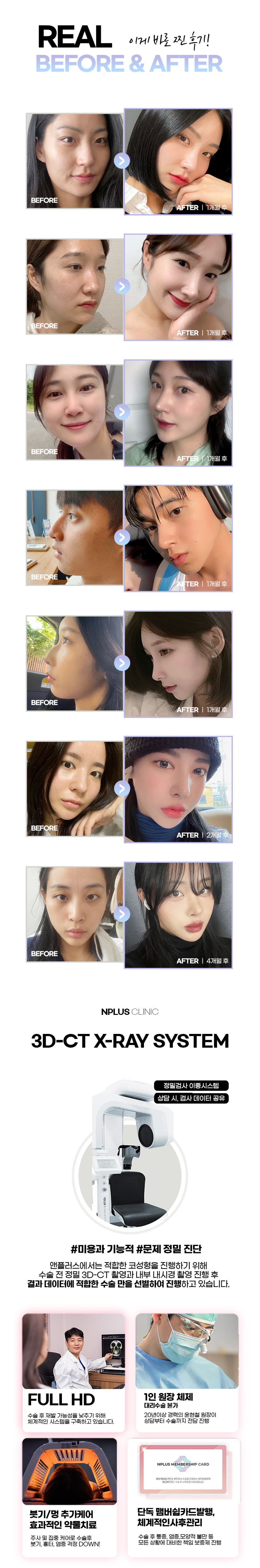 앤플러스에서 진행하고 있는 무보형물 코성형이벤트 관련 이미지 4