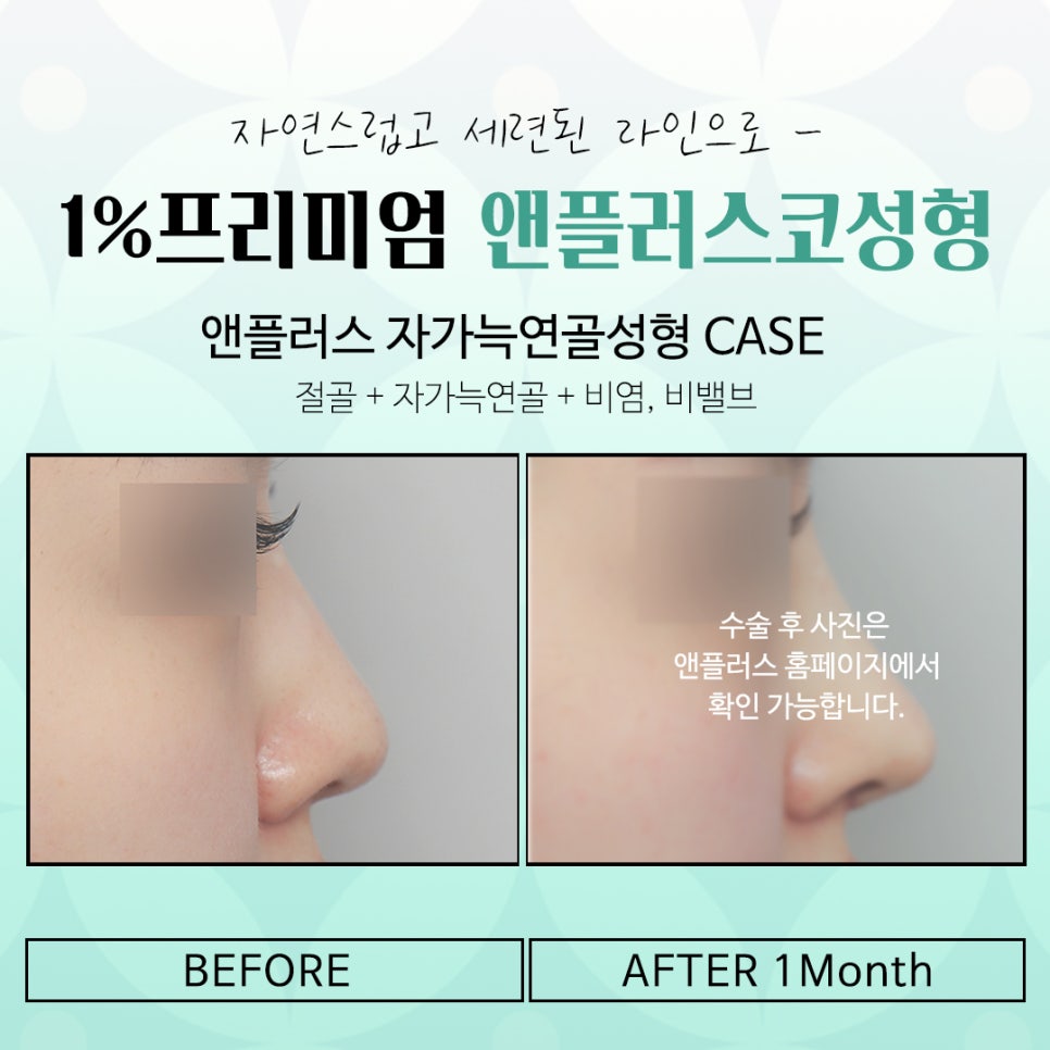 늑연골코성형에 대해 자세히 알아보고 관련 이미지 15