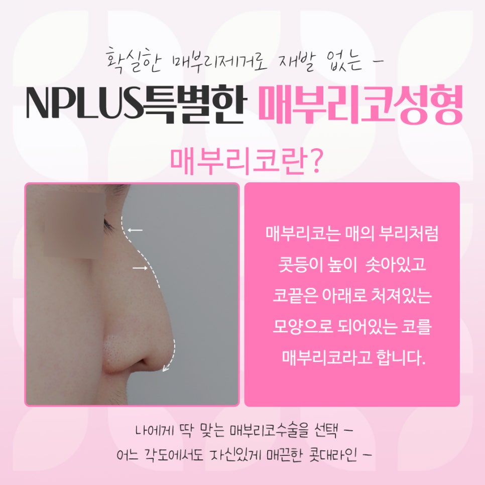 매부리코수술전후 비교를 한다면 관련 이미지 3