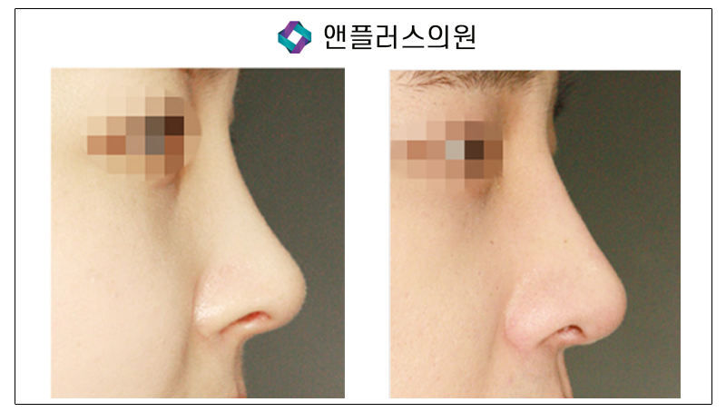 비염수술+코성형, 동시에 진행하자! 관련 이미지 5