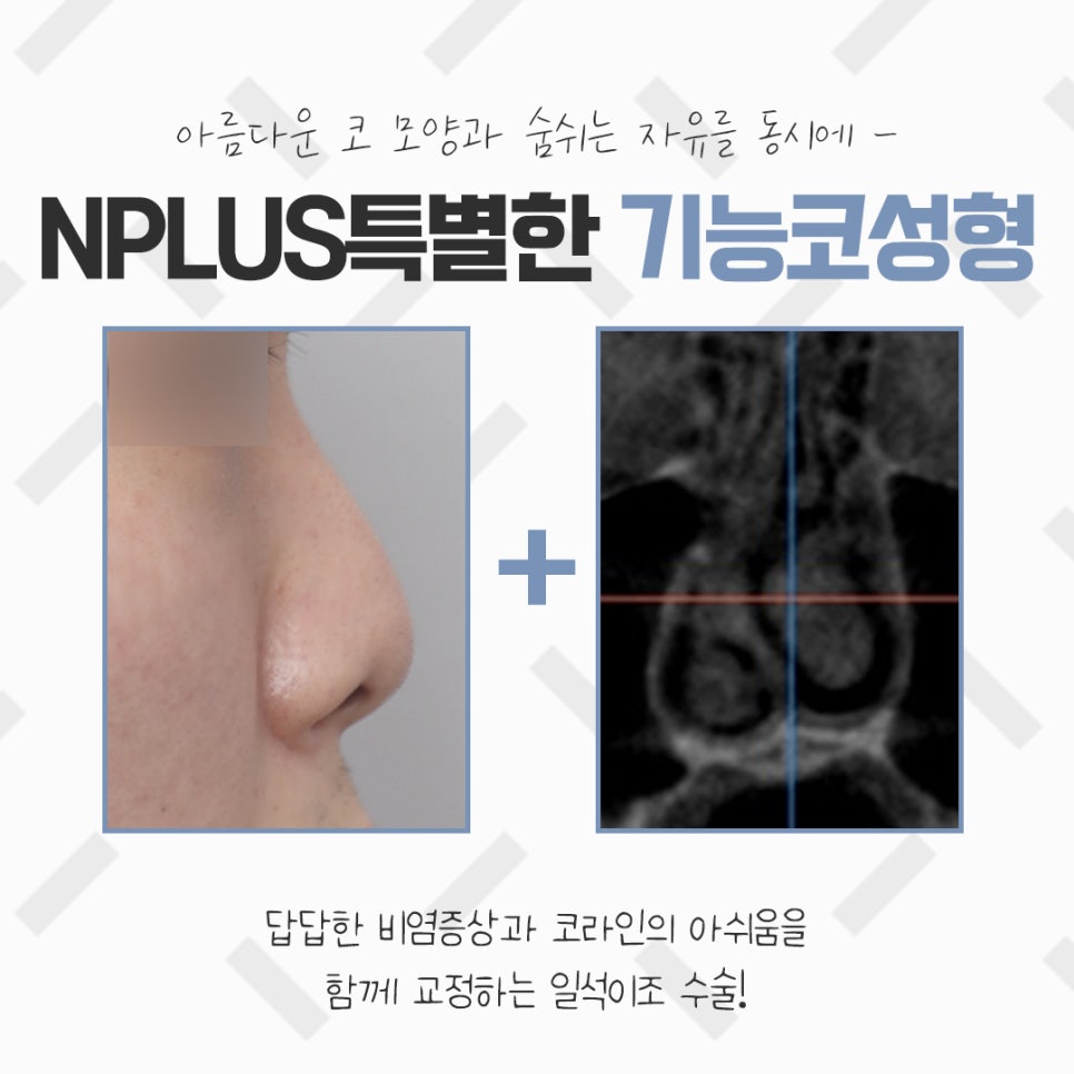 The Importance of Choosing Coverage for Nose Surgery image 3