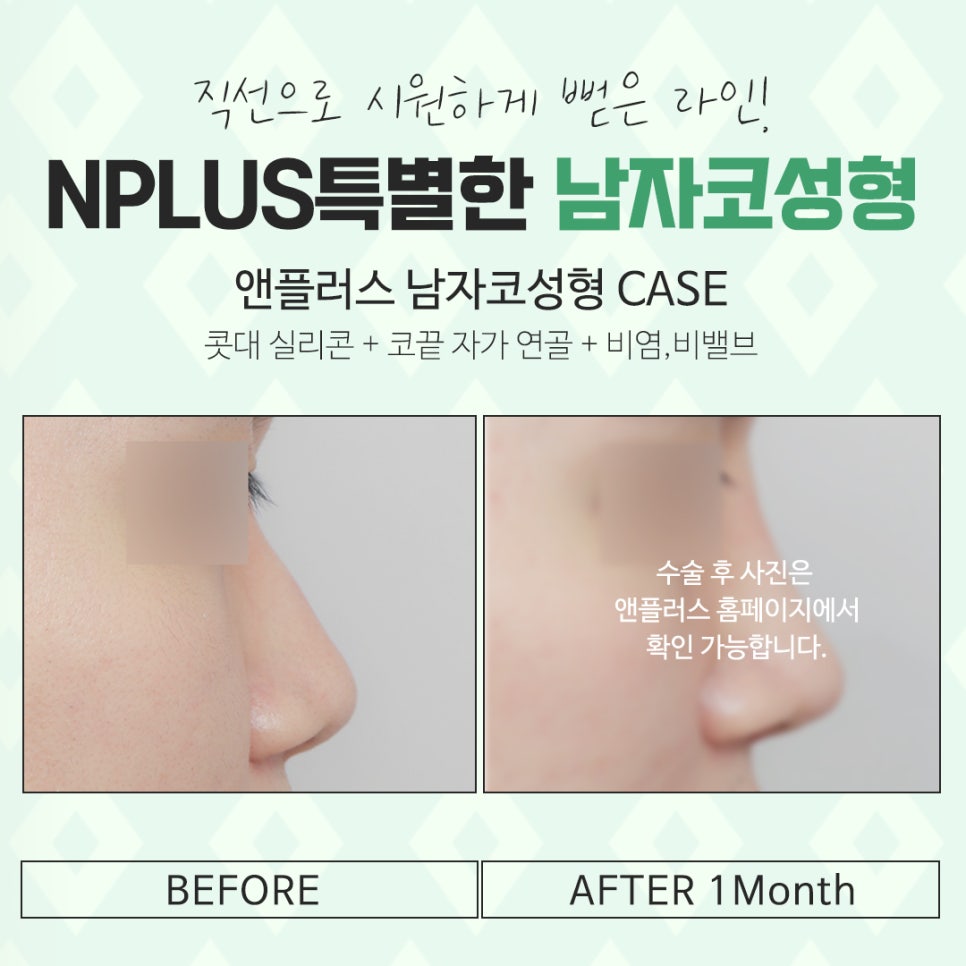 남자코수술후기 멋있고 자연스러운 라인으로 관련 이미지 15