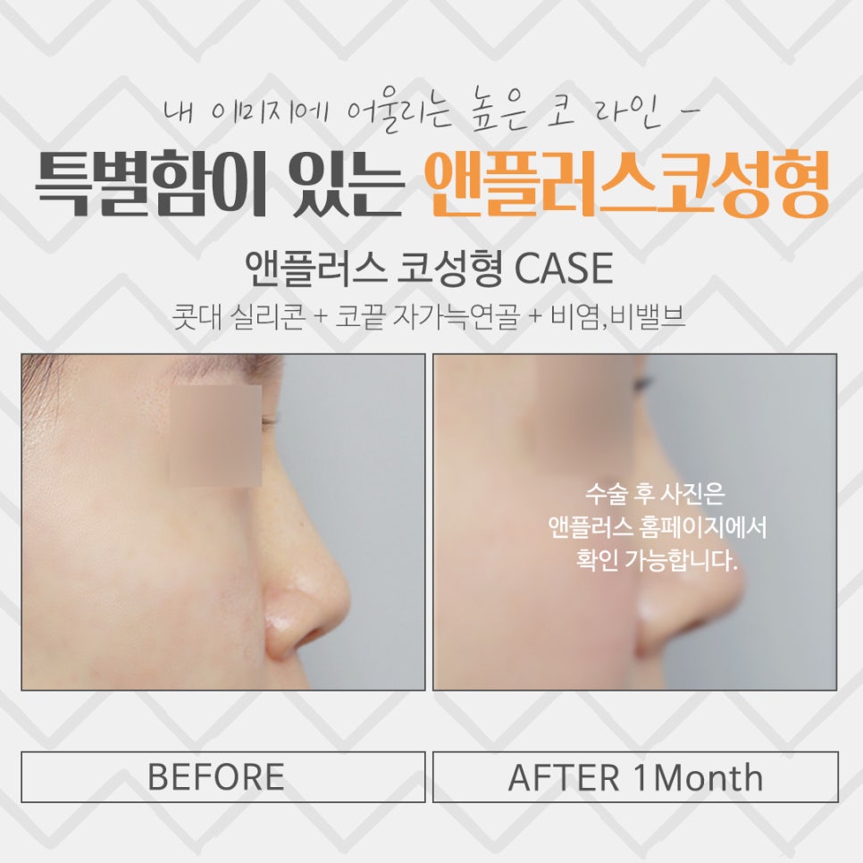 코성형후기 예쁘고 자연스러운 라인으로 관련 이미지 13