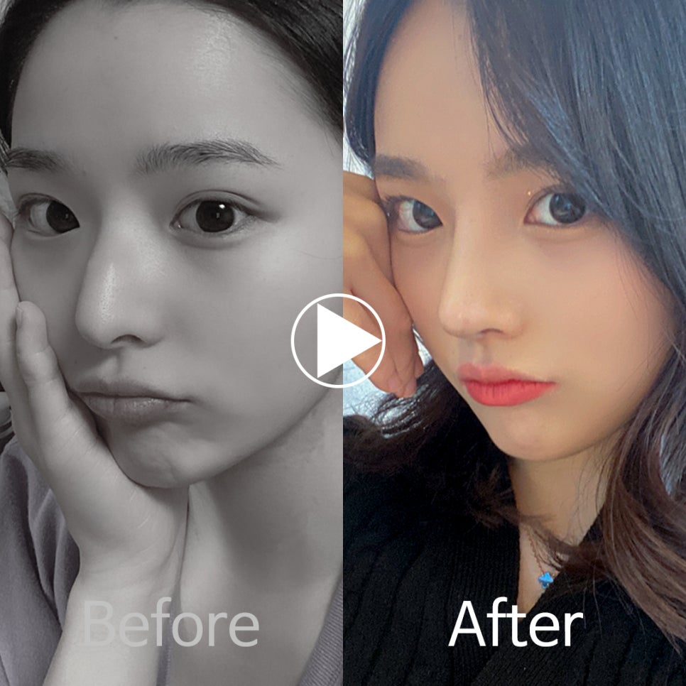 🎀앤플러스 코성형 모델모집🎀 관련 이미지 5