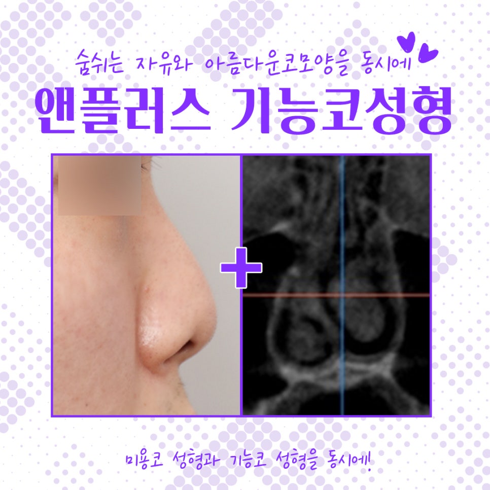 Nose Surgery Review from Anplus Plastic Surgery image 3