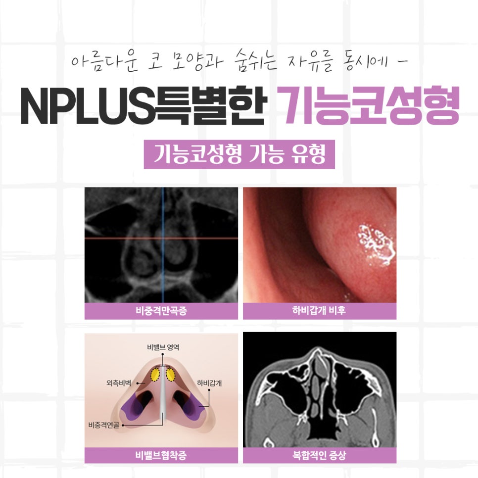 코성형후기 자연스럽고 아름답게 관련 이미지 5