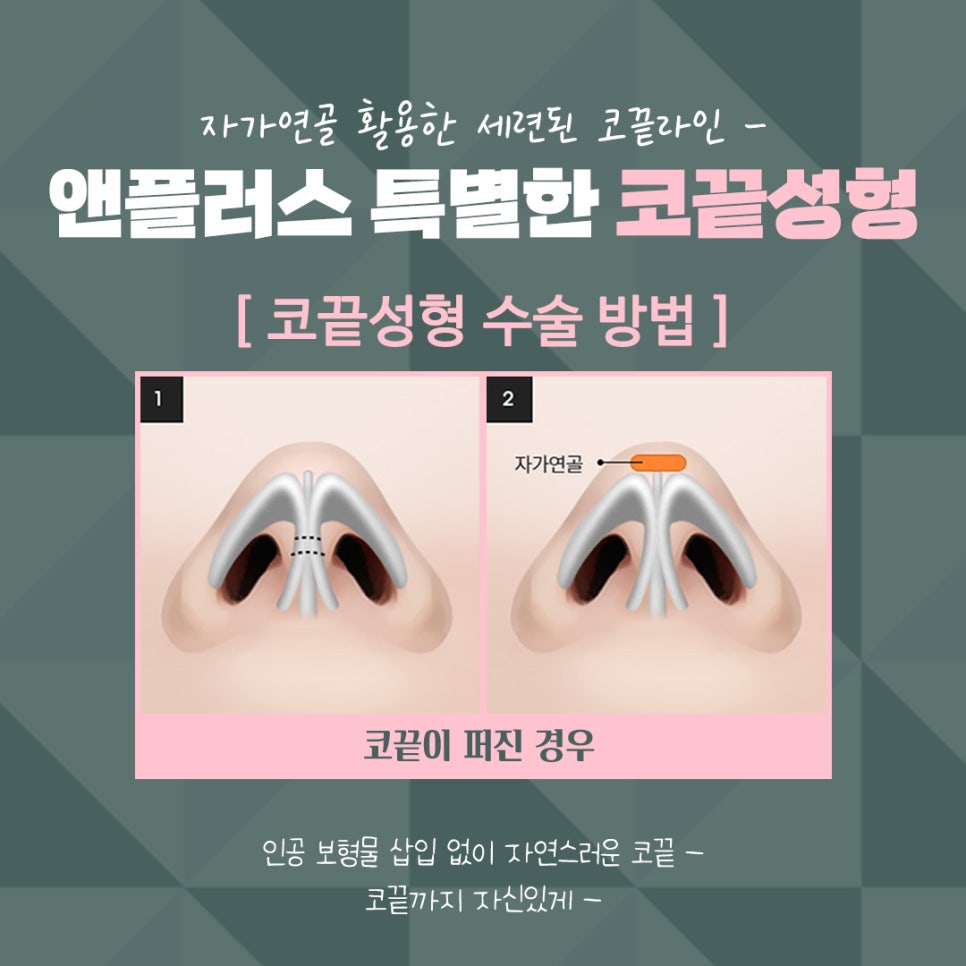 Nasal Tip Surgery Review Using Autologous Cartilage image 10
