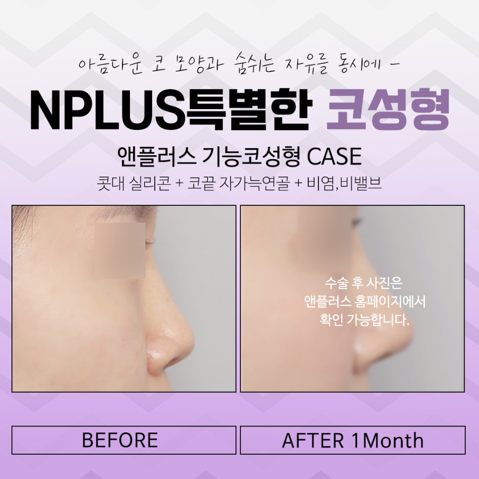 코수술전후 자연스러운 라인으로 관련 이미지 15