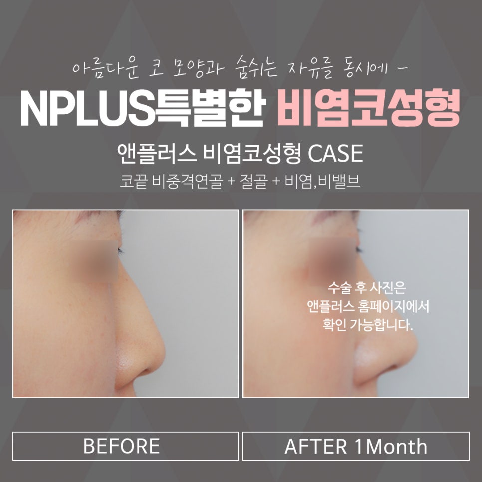 비염의원인 정확하게 진단하여 관련 이미지 12