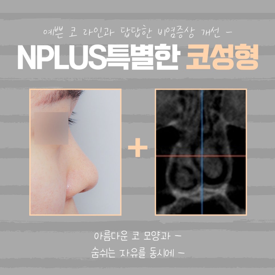 The Importance of Choosing Low Nose Augmentation Reviews image 4