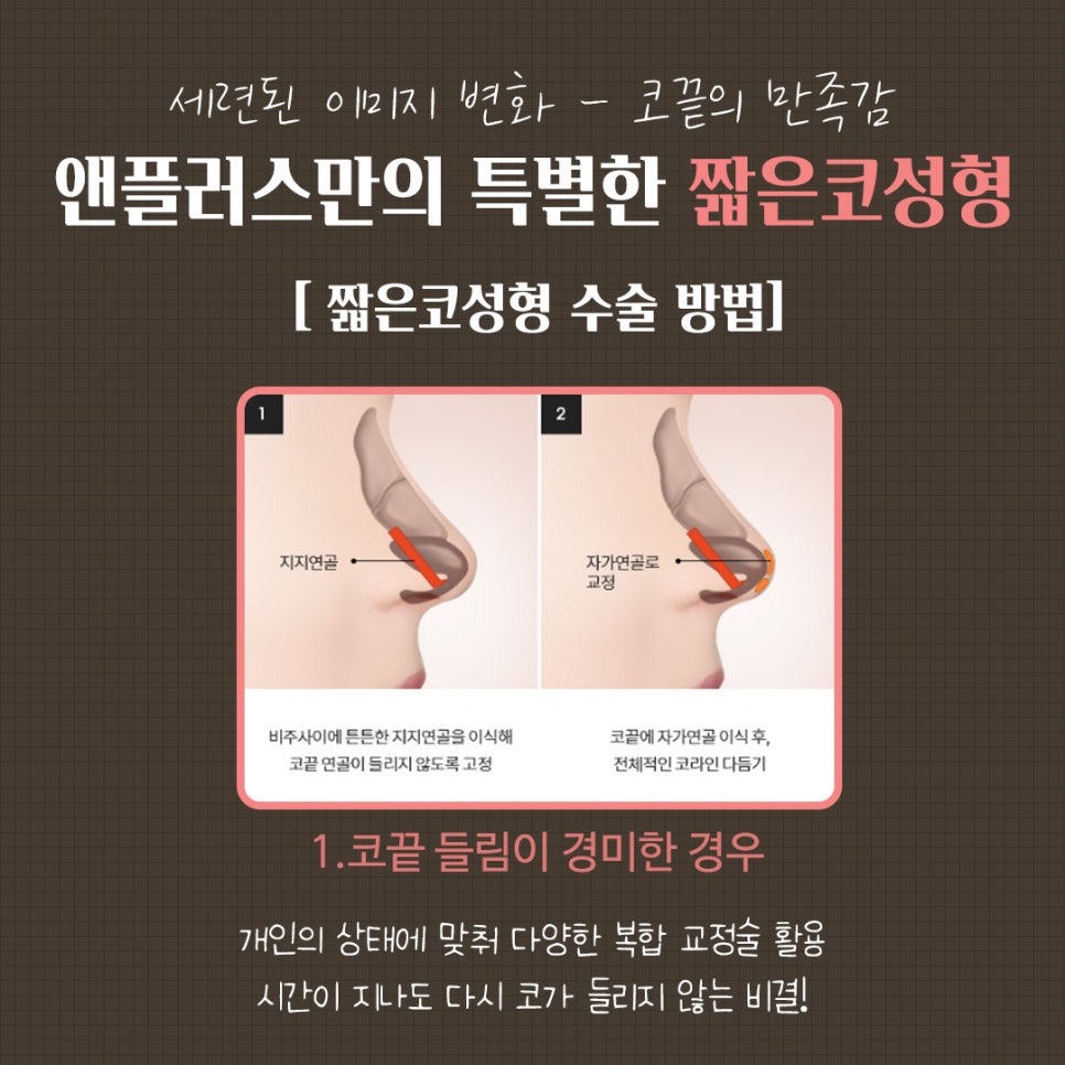 들창코수술후기 튼튼한 비주지지대 관련 이미지 8