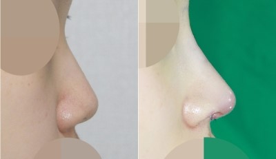 앤플러스성형외과 낮은코, 복코 전후사진 관련 이미지 1
