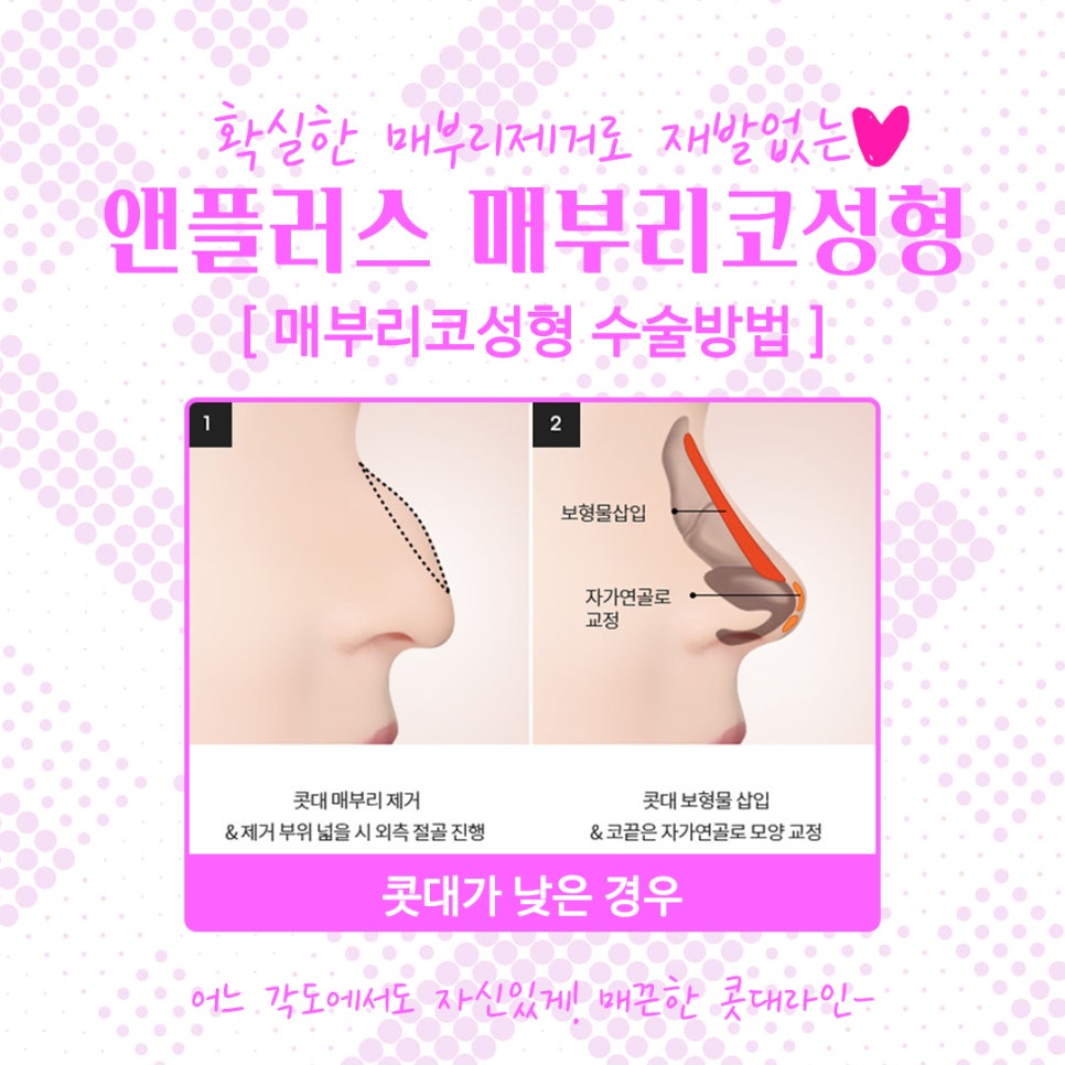 Women’s Hump Nose: The Hump Should Be Cleanly Removed image 8