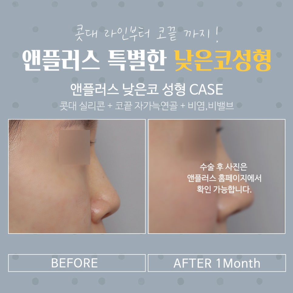 Transforming a Low Nose with a Beautiful Nose Line image 14