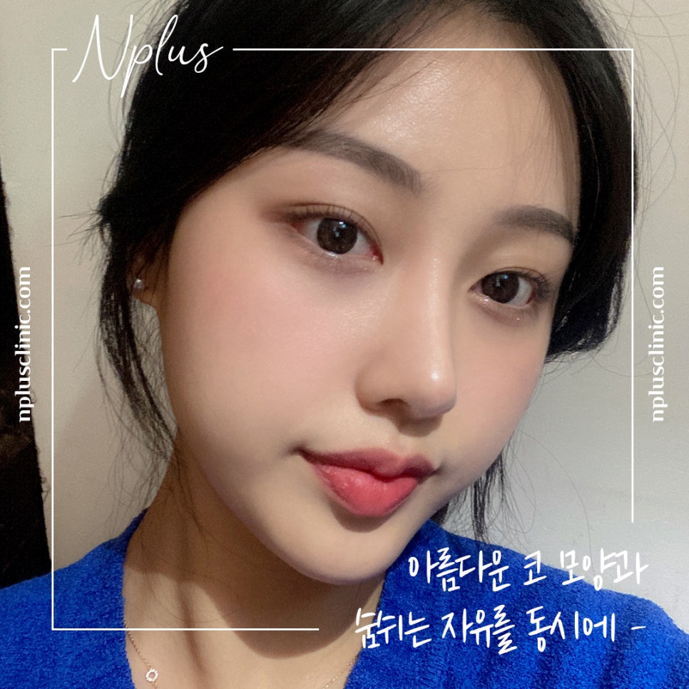 콧볼축소수술 확실한 교정으로 관련 이미지 7