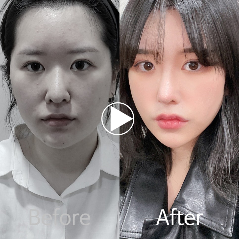 🎀앤플러스 코성형 모델모집🎀 관련 이미지 6