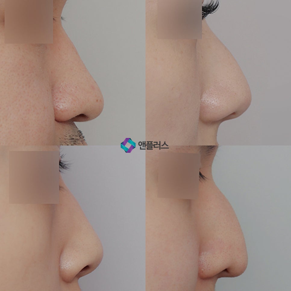 Hooked Nose Before-and-After Photos for a Softer Look image 2