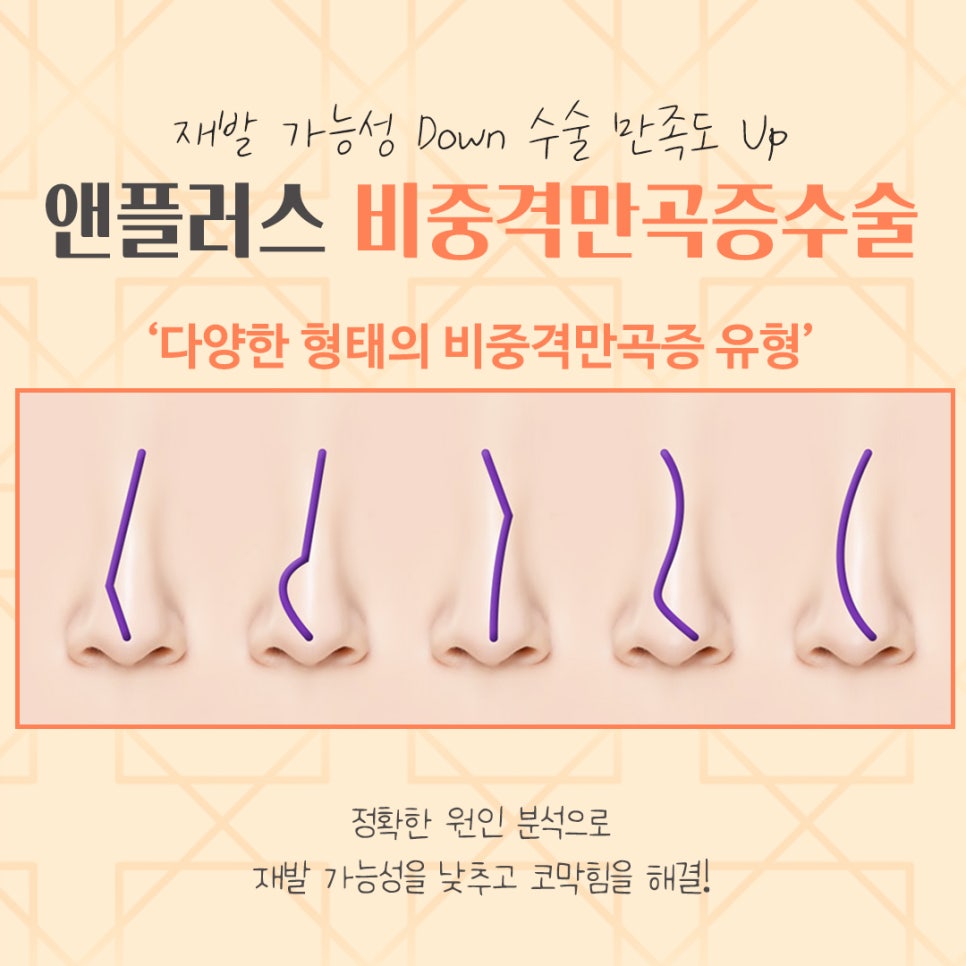 비중격만곡증수술후기 코 내부를 정확하게 파악해야 관련 이미지 8