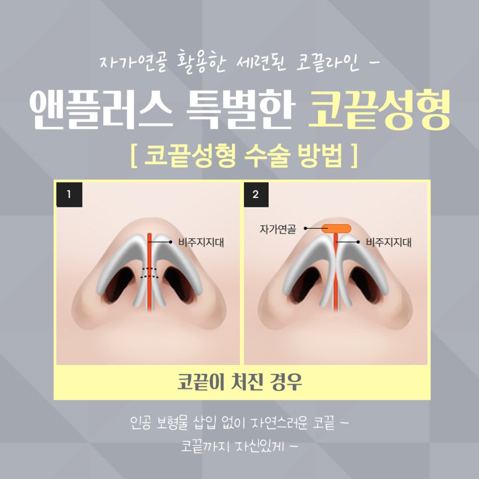Tip Plasty Through Tip Cartilage Stitching image 9