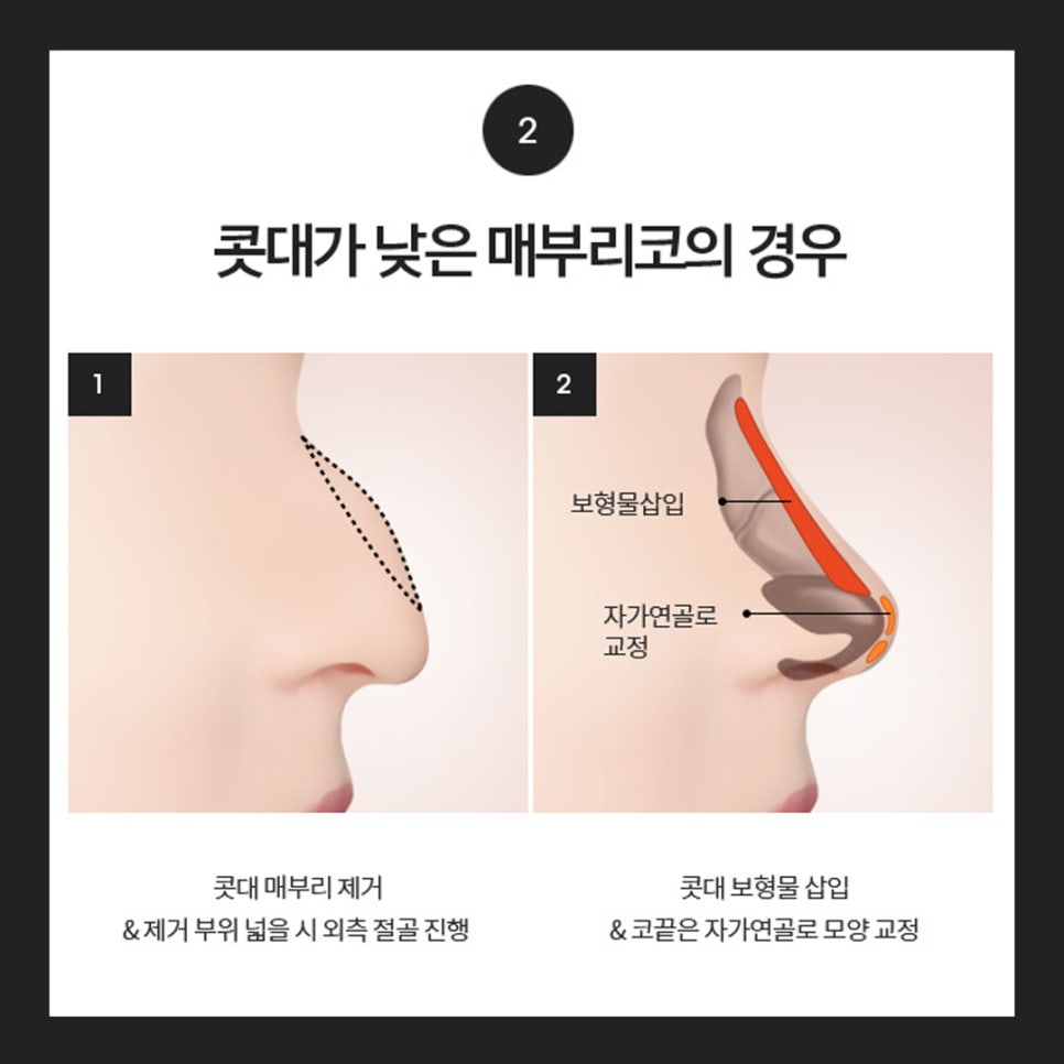 Hooked Nose Before-and-After Photos for a Softer Look image 7