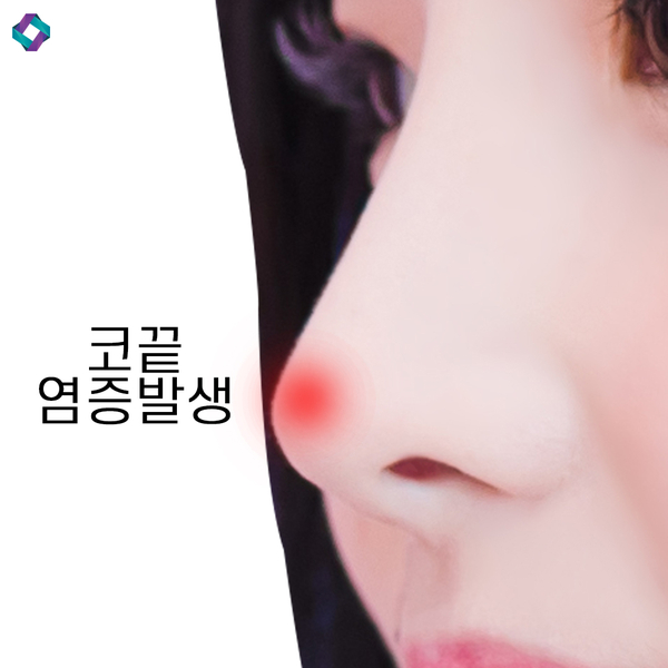 늑연골 코성형 : 자가연골의 장점과 단점 (자가연골 비교) 관련 이미지 5